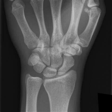 ap on wrist